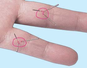 Alternative medicine. Treatment with acupuncture su jok needles. Su jok therapy ( acupuncture ).